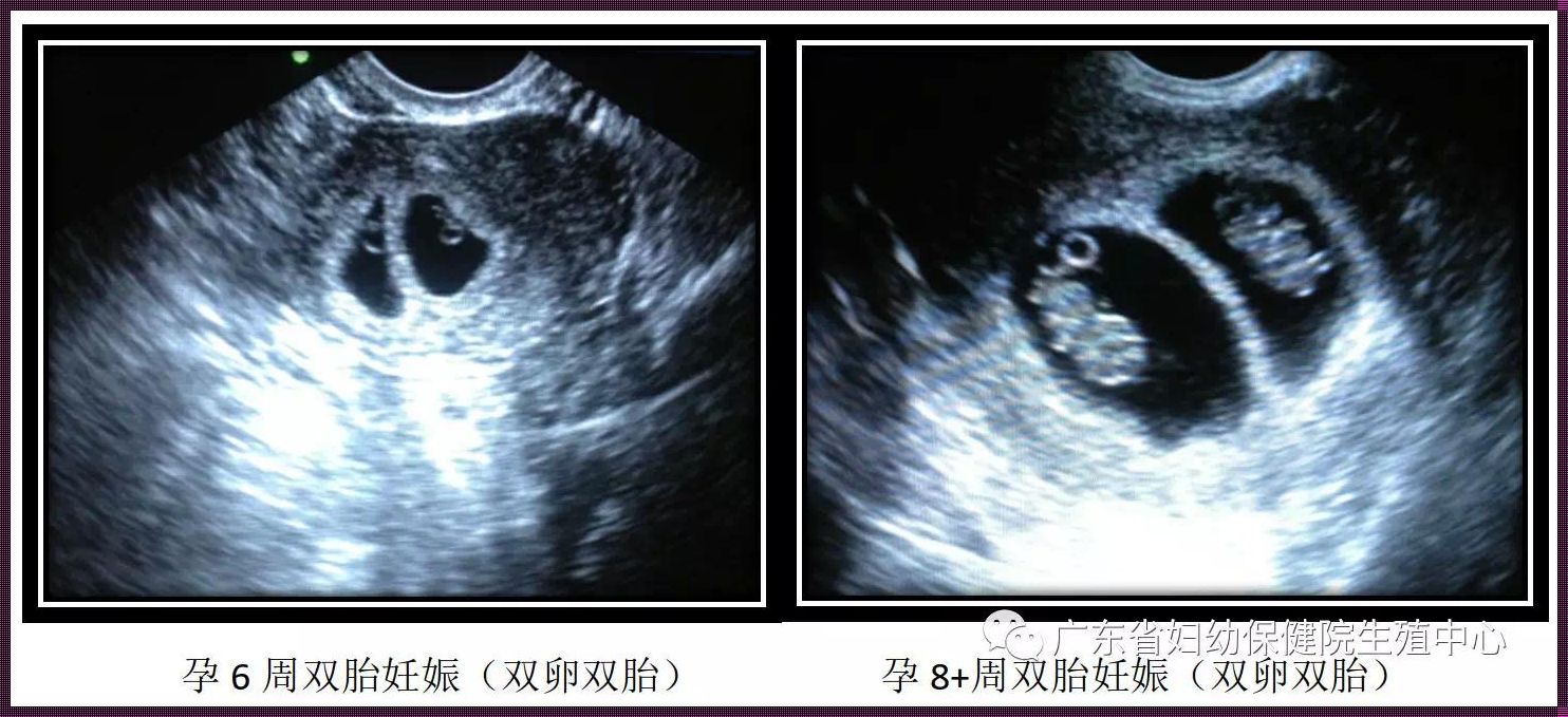 揭开双绒毛膜双羊膜囊单卵双胎的神秘面纱：全方位深入解析