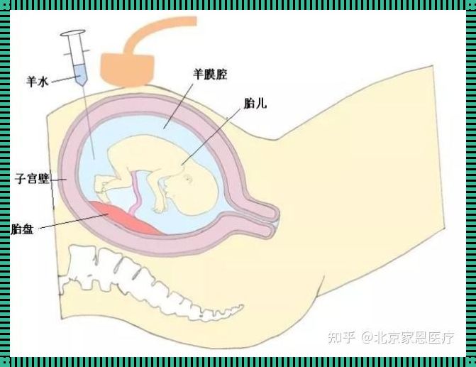 羊水穿刺：一项精确的产前诊断技术
