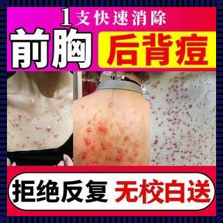 背后痘痘去除秘籍：探索自然疗法与生活调整